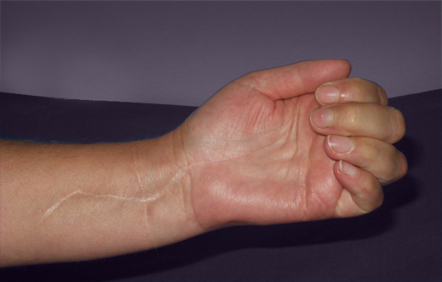 After the reconstruction of the median nerve